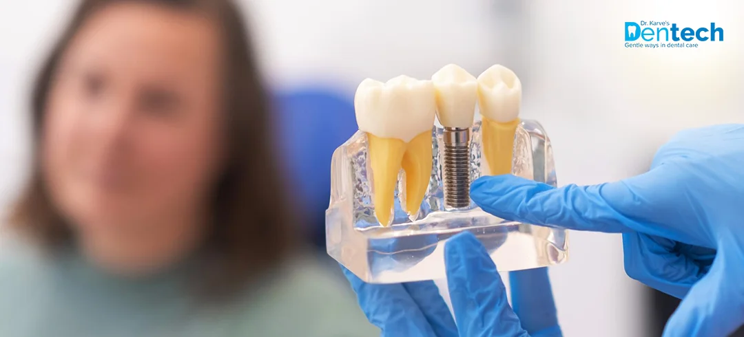 Dental Implant Treatment in Powai at Dr. Karve's Dentech